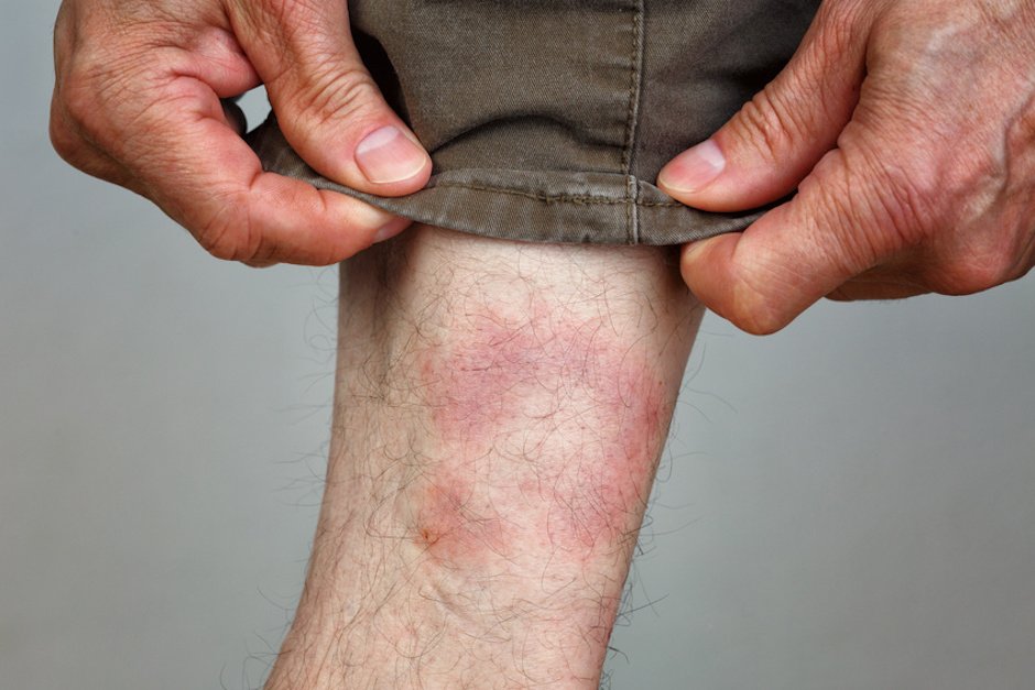 Wanderröte, Borreliose